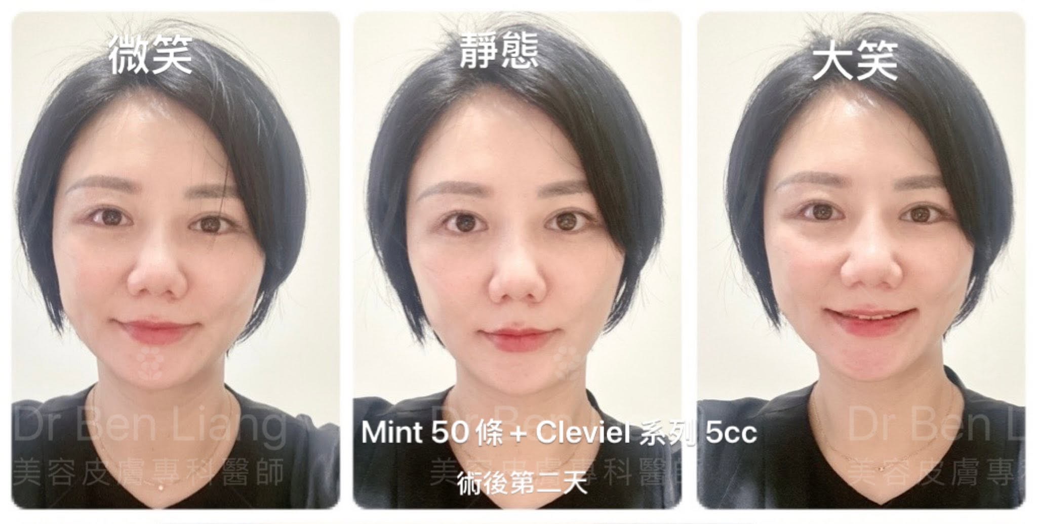 Mint Lift 復位埋線術後第二天表情動態案例